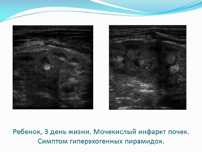 Ребенок, 3 день жизни. Мочекислый инфаркт почек. Симптом гиперэхогенных пирамидок.